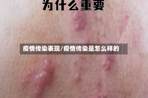 疫情传染表现/疫情传染是怎么样的